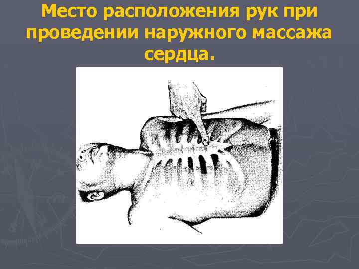 Место расположения рук при проведении наружного массажа сердца. 