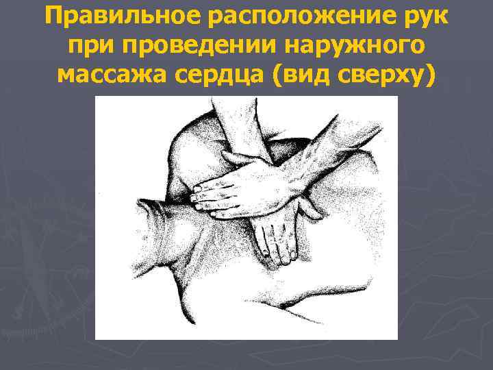 Правильное расположение рук при проведении наружного массажа сердца (вид сверху) 