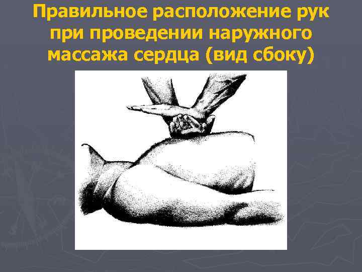 Правильное расположение рук при проведении наружного массажа сердца (вид сбоку) 