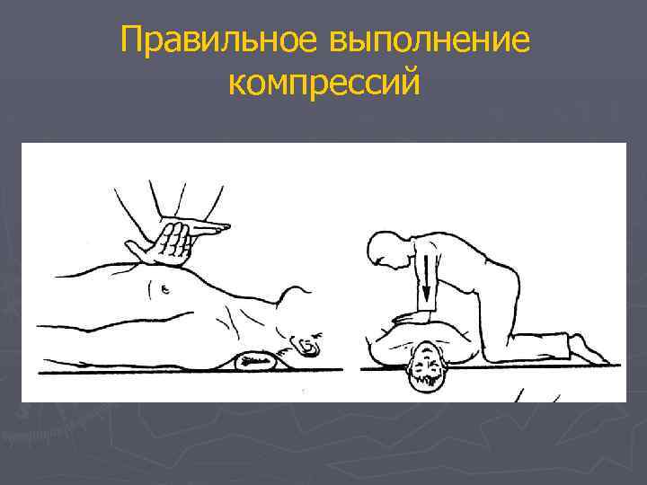 Правильное выполнение компрессий 