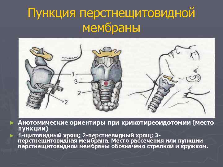 Пункция перстнещитовидной мембраны ► ► Анотомические ориентиры при крикотиреоидотомии (место пункции) 1 -щитовидный хрящ;