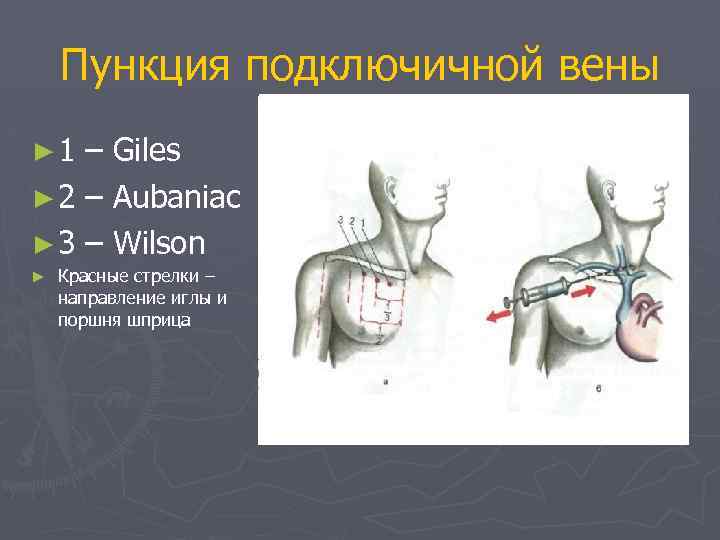 Пункция подключичной вены ► 1 – Giles ► 2 – Aubaniac ► 3 –