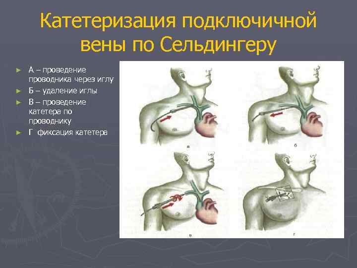 Катетеризация подключичной вены по Сельдингеру ► ► А – проведение проводника через иглу Б