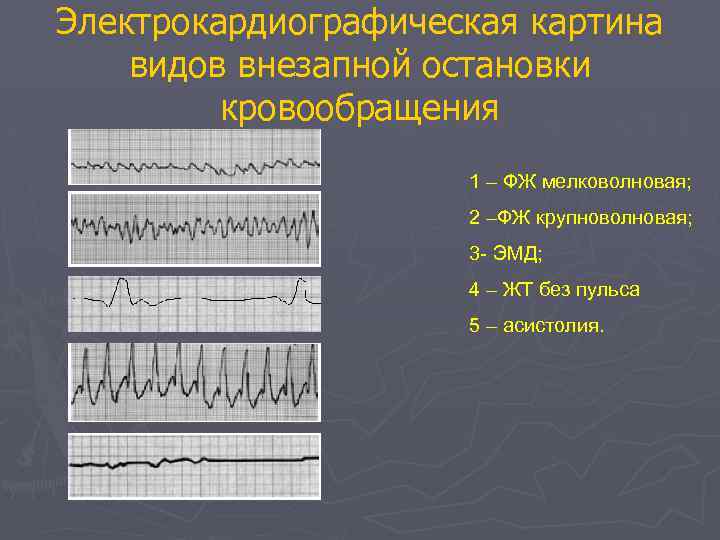 Электрокардиографическая картина видов внезапной остановки кровообращения 1 – ФЖ мелковолновая; 2 –ФЖ крупноволновая; 3