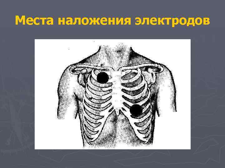 Места наложения электродов 