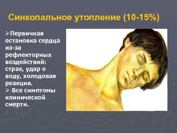 Синкопальное утопление (10 -15%) ØПервичная остановка сердца из-за рефлекторных воздействий: страх, удар о воду,