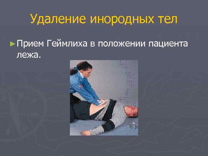 Удаление инородных тел ► Прием лежа. Геймлиха в положении пациента 