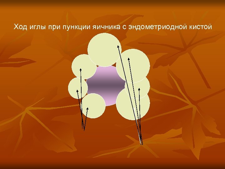 Ход иглы при пункции яичника с эндометриодной кистой 