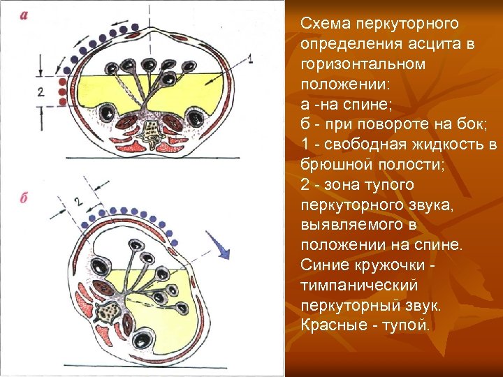 Схема перкуторного определения асцита в горизонтальном положении: а -на спине; б - при повороте
