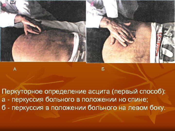 А Б Перкуторное определение асцита (первый способ): а - перкуссия больного в положении но