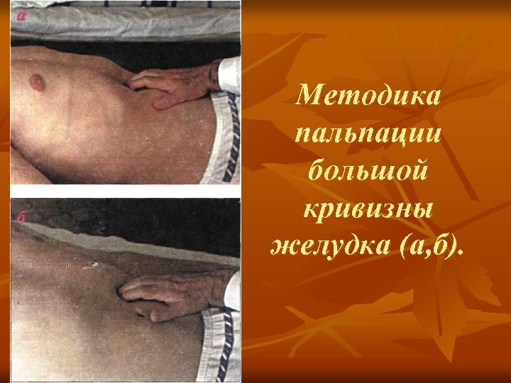 Методика пальпации большой кривизны желудка (а, б). 