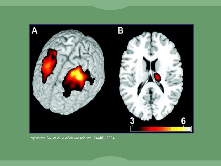 Apkarian AV, et al. J of Neuroscience, 24(46), 2004. 