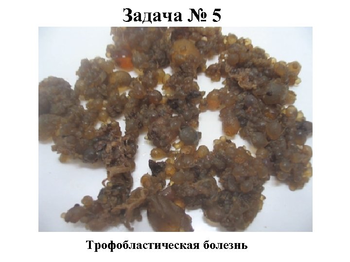 Задача № 5 Трофобластическая болезнь 