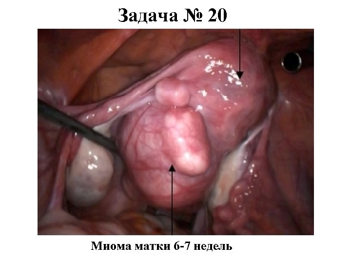 Задача № 20 Миома матки 6 -7 недель 