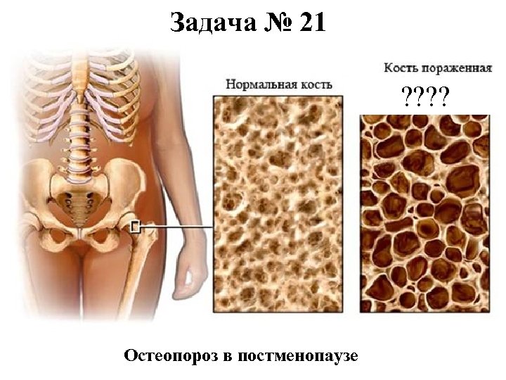 Задача № 21 ? ? Остеопороз в постменопаузе 