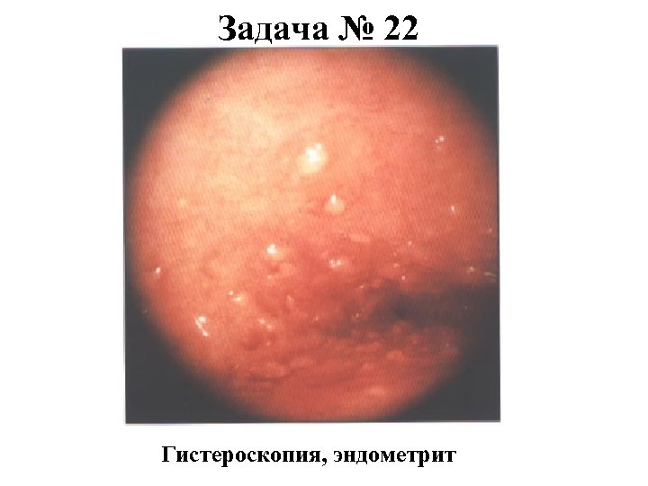 Задача № 22 Гистероскопия, эндометрит 