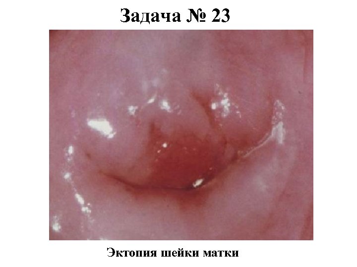 Задача № 23 Эктопия шейки матки 