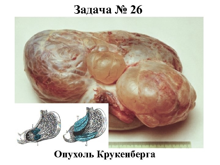 Задача № 26 Опухоль Крукенберга 