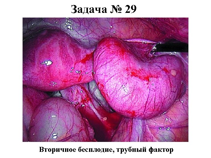 Задача № 29 Вторичное бесплодие, трубный фактор 