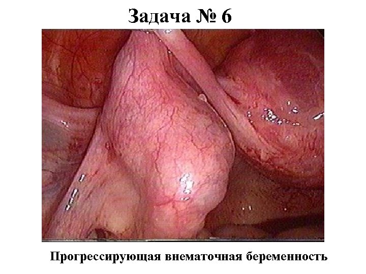 Задача № 6 Прогрессирующая внематочная беременность 