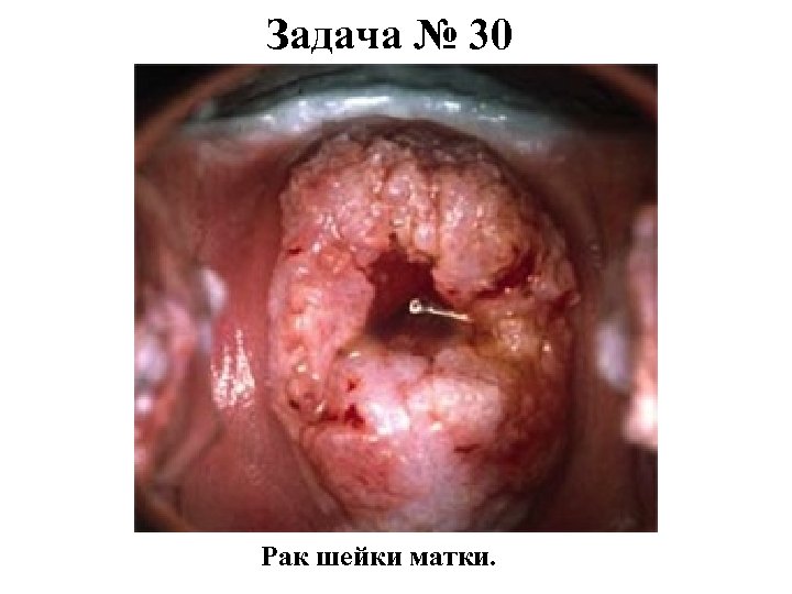 Задача № 30 Рак шейки матки. 