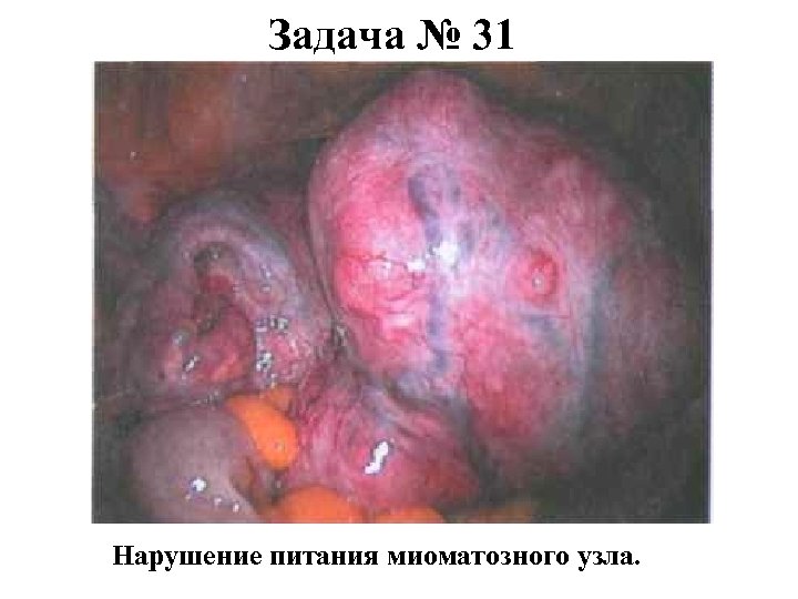 Задача № 31 Нарушение питания миоматозного узла. 