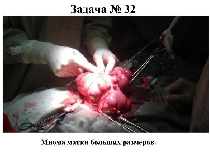 Задача № 32 Миома матки больших размеров. 