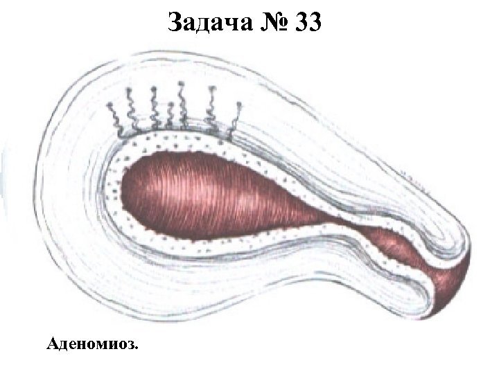 Задача № 33 Аденомиоз. 