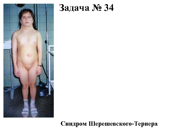 Задача № 34 Синдром Шерешевского-Тернера 