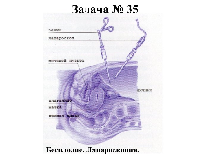 Задача № 35 Бесплодие. Лапароскопия. 