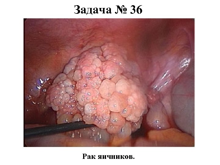 Задача № 36 Рак яичников. 