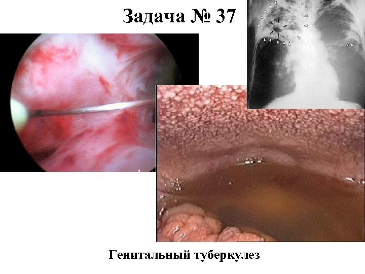 Задача № 37 Генитальный туберкулез 