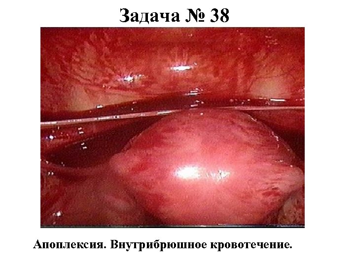 Задача № 38 Апоплексия. Внутрибрюшное кровотечение. 