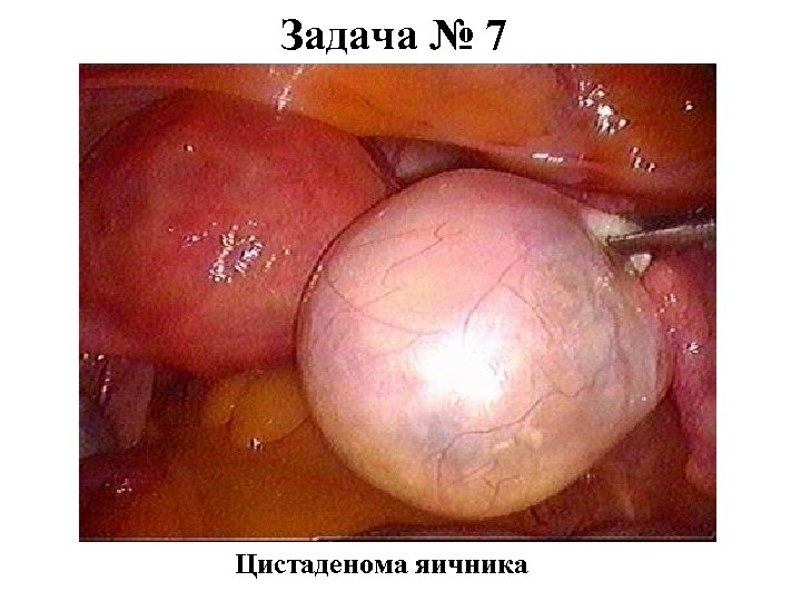 Задача № 7 Цистаденома яичника 