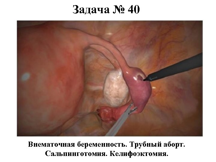 Задача № 40 Внематочная беременность. Трубный аборт. Сальпинготомия. Келифоэктомия. 