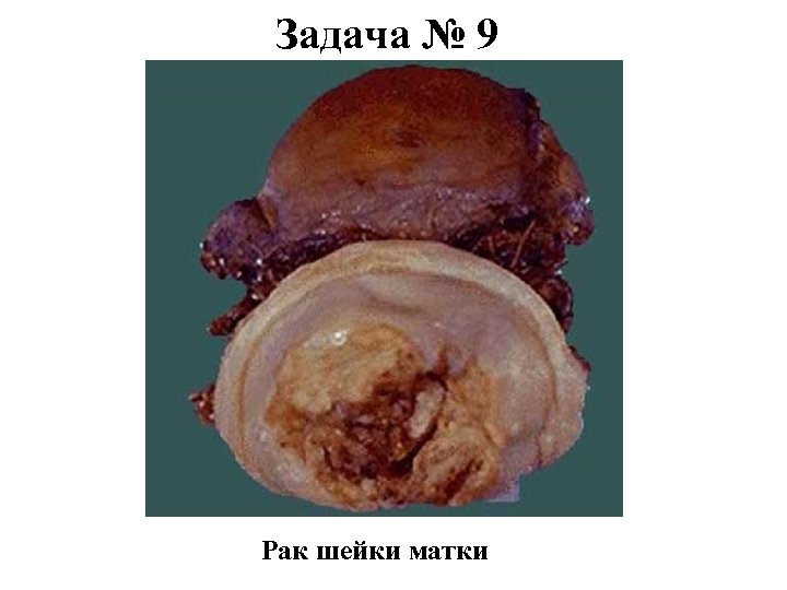 Задача № 9 Рак шейки матки 