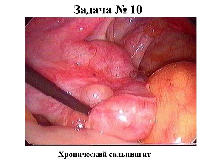 Задача № 10 Хронический сальпингит 
