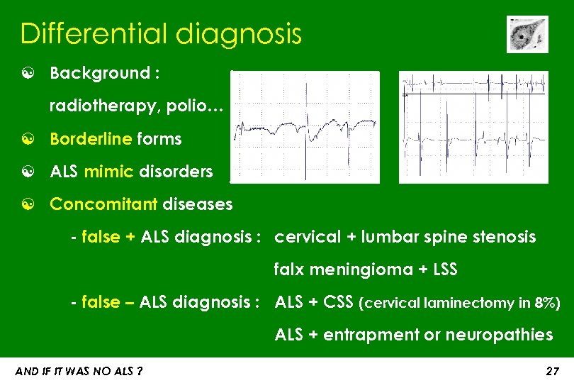 Differential diagnosis ☯ Background : radiotherapy, polio… ☯ Borderline forms ☯ ALS mimic disorders