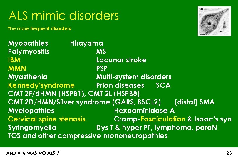 ALS mimic disorders The more frequent disorders Myopathies Hirayama Polymyositis MS IBM Lacunar stroke