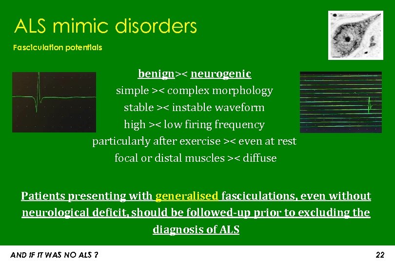 ALS mimic disorders Fasciculation potentials benign>< neurogenic simple >< complex morphology stable >< instable