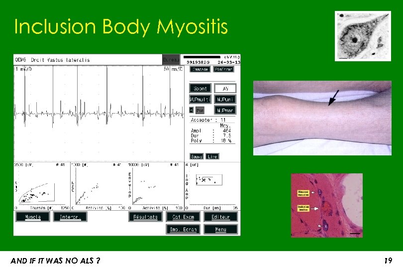 Inclusion Body Myositis AND IF IT WAS NO ALS ? 19 