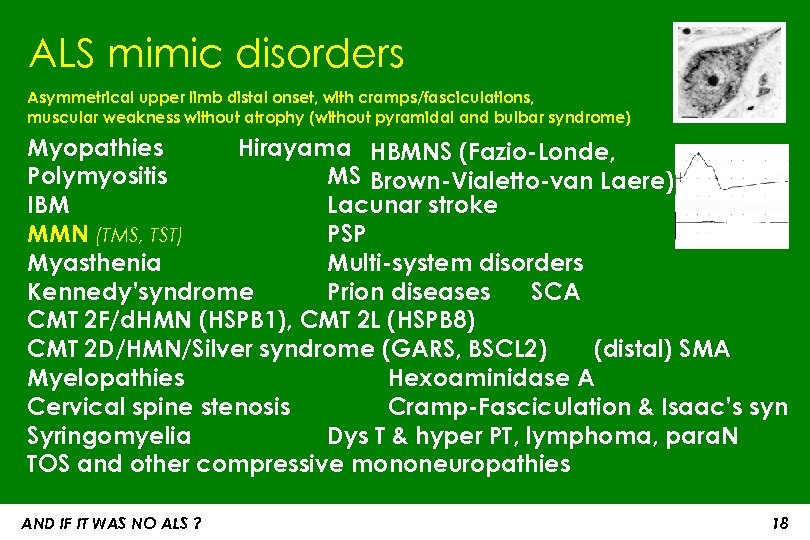 ALS mimic disorders Asymmetrical upper limb distal onset, with cramps/fasciculations, muscular weakness without atrophy