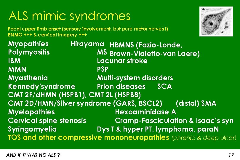 ALS mimic syndromes Focal upper limb onset (sensory involvement, but pure motor nerves !)