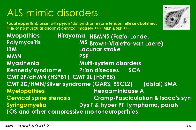 ALS mimic disorders Focal upper limb onset with pyramidal syndrome (one tendon reflexe abolished,