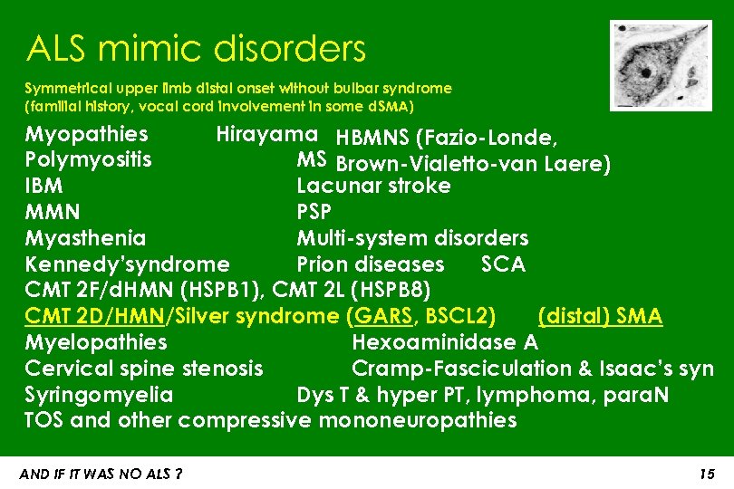 ALS mimic disorders Symmetrical upper limb distal onset without bulbar syndrome (familial history, vocal