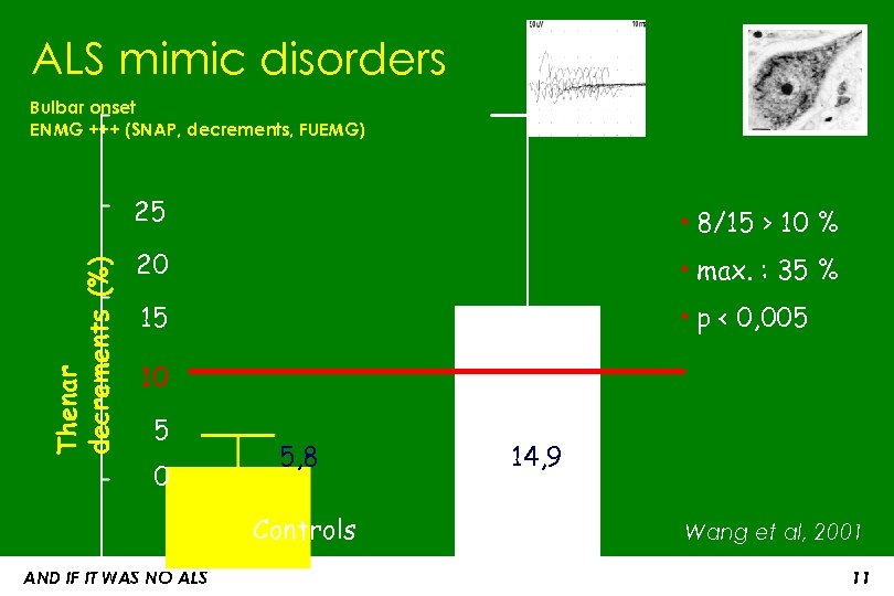 ALS mimic disorders Bulbar onset ENMG +++ (SNAP, decrements, FUEMG) Thenar decrements (%) 25