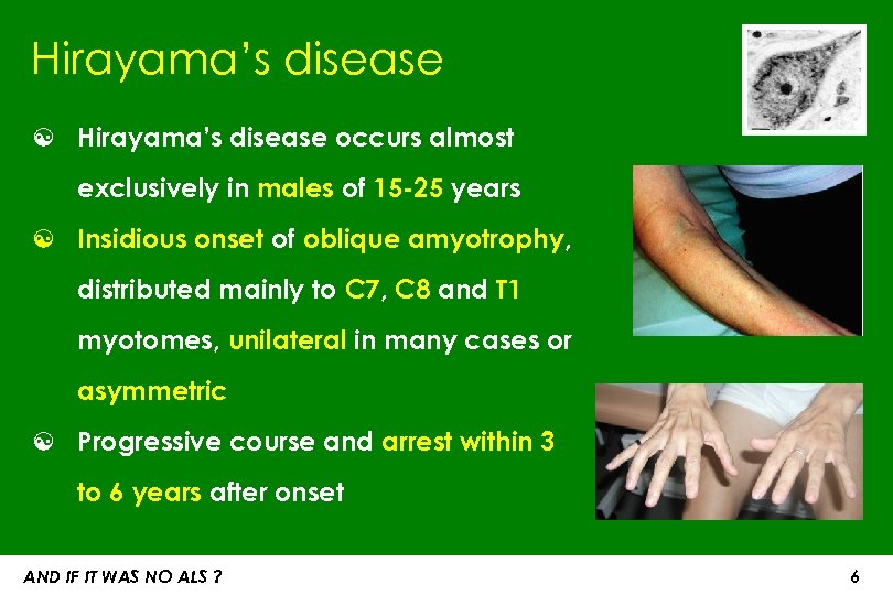 Hirayama’s disease ☯ Hirayama’s disease occurs almost exclusively in males of 15 -25 years