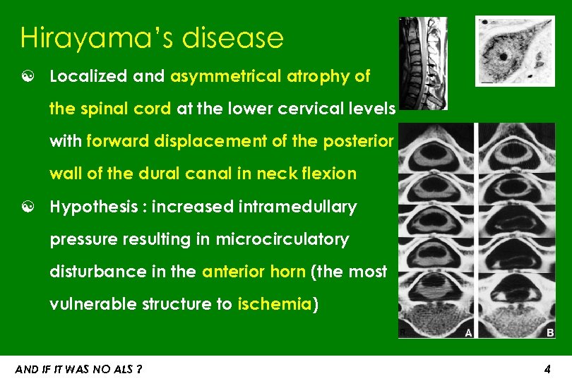 Hirayama’s disease ☯ Localized and asymmetrical atrophy of the spinal cord at the lower