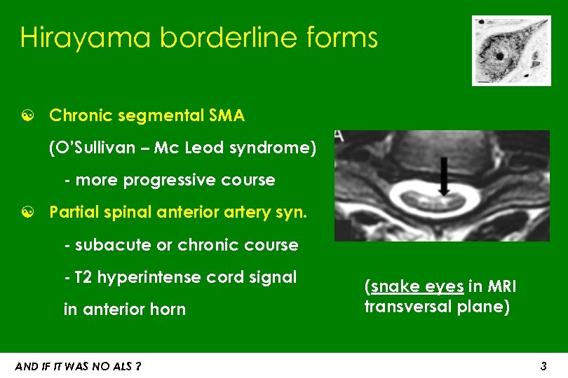 Hirayama borderline forms ☯ Chronic segmental SMA (O’Sullivan – Mc Leod syndrome) - more