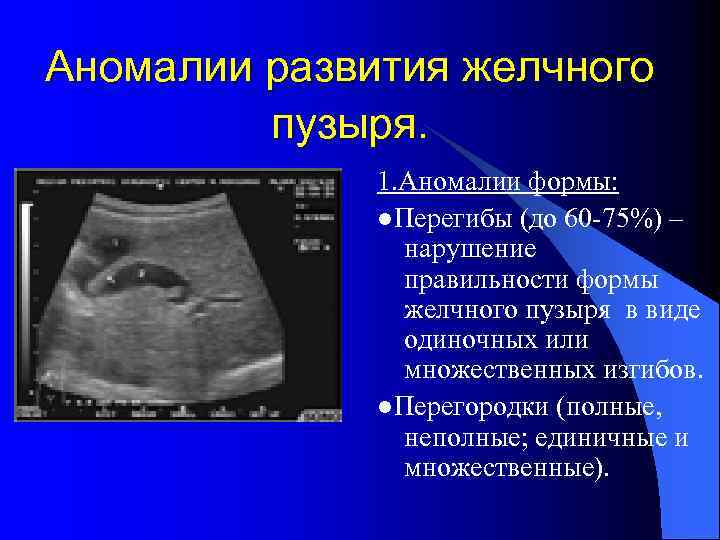 Аномалии развития желчного пузыря. 1. Аномалии формы: ●Перегибы (до 60 -75%) – нарушение правильности